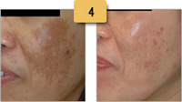 Melasma Before and After Pictures Sm 4