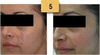 Melasma Before and After Pictures Sm 5