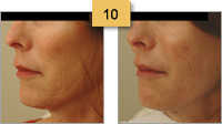 Perlane Injections Before and After Pictures Sm 10
