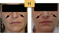 Perlane Injections Before and After Pictures Sm 11