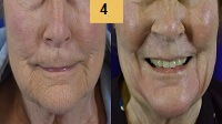 Profractional Laser Resurfacing Before and After Pictures Sm 4