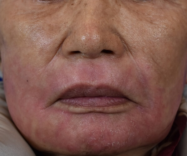 Profractional Laser Resurfacing After Pictures 7