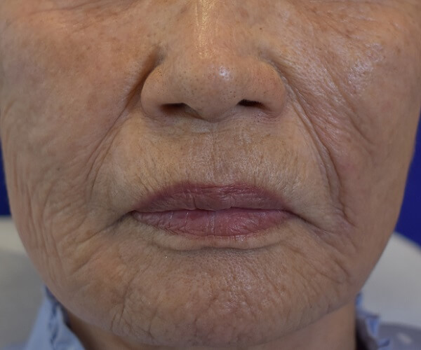 Profractional Laser Resurfacing Before Pictures 7