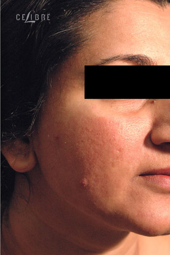 Profractional Laser Resurfacing After Pictures 6