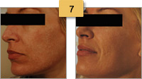 Profractional Laser Resurfacing Before and After Pictures Sm 7