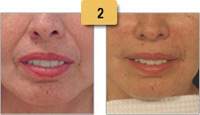 Radiesse Injections Before and After Pictures Sm 2