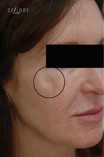 Restylane Injections Before Pictures 10