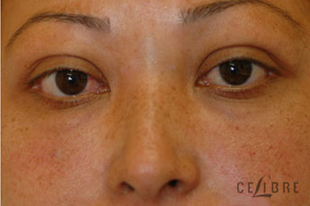 Restylane Injections After Pictures 11