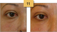 Restylane Injections Before and After Pictures Sm 11