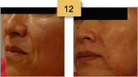 Restylane Injections Before and After Pictures Sm 12