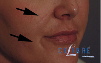 Restylane Injections Before Pictures 15