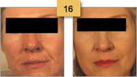 Restylane Injections Before and After Pictures Sm 16