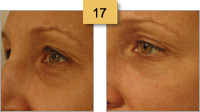 Restylane Injections Before and After Pictures Sm 17