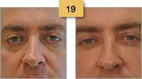 Restylane Injections Before and After Pictures Sm 19