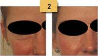 Restylane Injections Before and After Pictures Sm 2