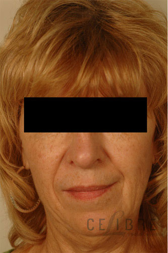 Restylane Injections Before Pictures 6