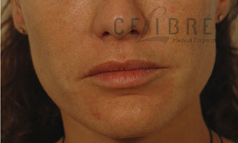 Restylane Injections After Pictures 7