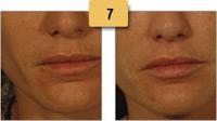 Restylane Injections Before and After Pictures Sm 7
