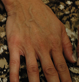 Restylane Lyft Hands Before Picture 21