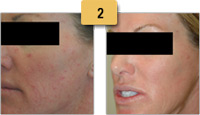 Rosacea treatment Before and After Pictures Sm 2