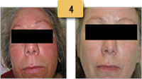 Rosacea treatment Before and After Pictures Sm 4