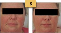 Rosacea treatment Before and After Pictures Sm 5