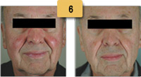 Rosacea treatment Before and After Pictures Sm 6