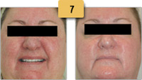 Rosacea treatment Before and After Pictures Sm 7
