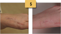 Surgery Scar Removal Before and After Pictures Sm 5