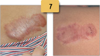 Keloid Scar Removal Before and After Pictures Sm 7