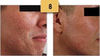 Textured Acne Scar Removal Before and After Pictures Sm 8