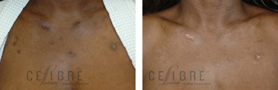 Dark Scar Removal Before After Photo