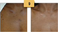 Picking Scar Removal Before and After Pictures Sm 9
