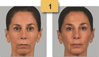 Sculptra Injections Before and After Pictures Sm 1