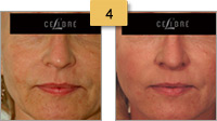 Sculptra Injections Before and After Pictures Sm 4