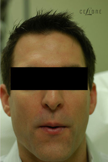 Sculptra Injections After Pictures 5