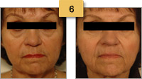Sculptra Injections Before and After Pictures Sm 6