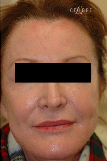 Cheek Augmentation After Photo