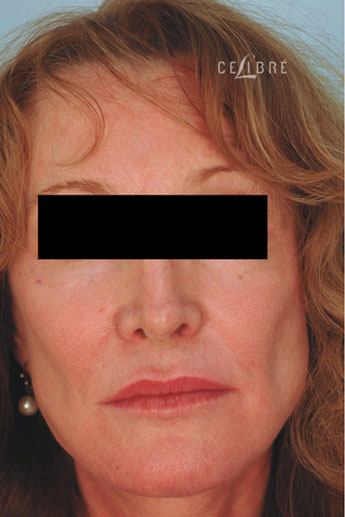 Cheek Augmentation Before Photo