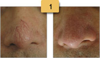 Spider Vein Removal Before and After Pictures Sm 1