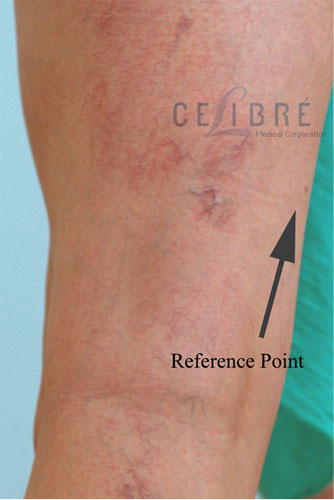 Before and After Spider Vein Removal on Leg - 2