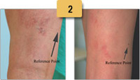 Spider Vein Removal Before and After Pictures Sm 2