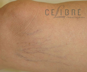 Spider Vein Removal Before Pictures 3