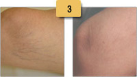 Spider Vein Removal Before and After Pictures Sm 3