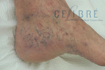 Spider Vein Removal Before Pictures 4