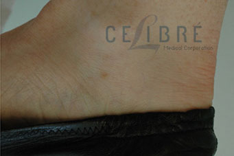 Spider Vein Removal After Pictures 5