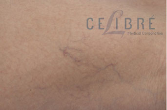 Spider Vein Removal Before Pictures 6