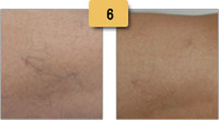Spider Vein Removal Before and After Pictures Sm 6