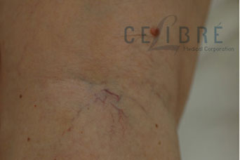 Spider Vein Removal Before Pictures 8