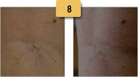 Spider Vein Removal Before and After Pictures Sm 8
